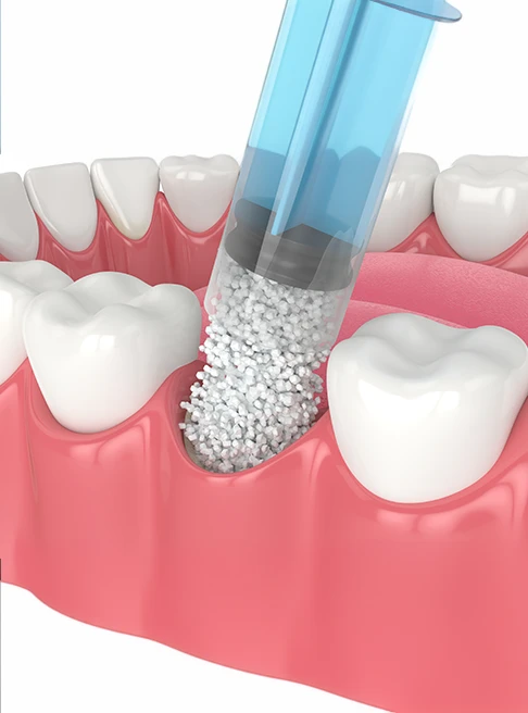 A dental bone grafting is a specialized