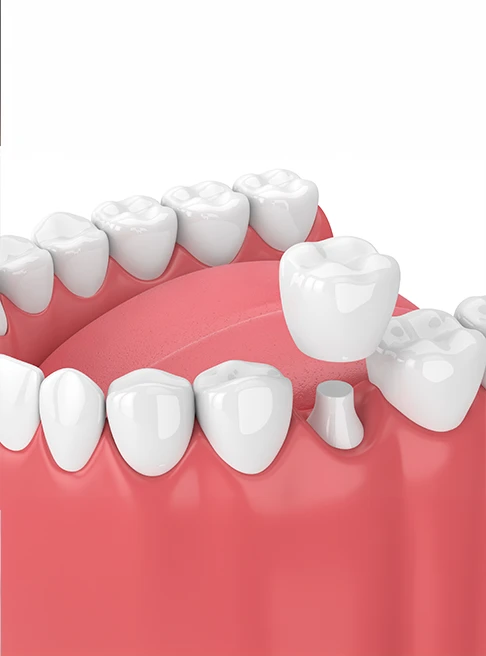 What Are Dental Crowns