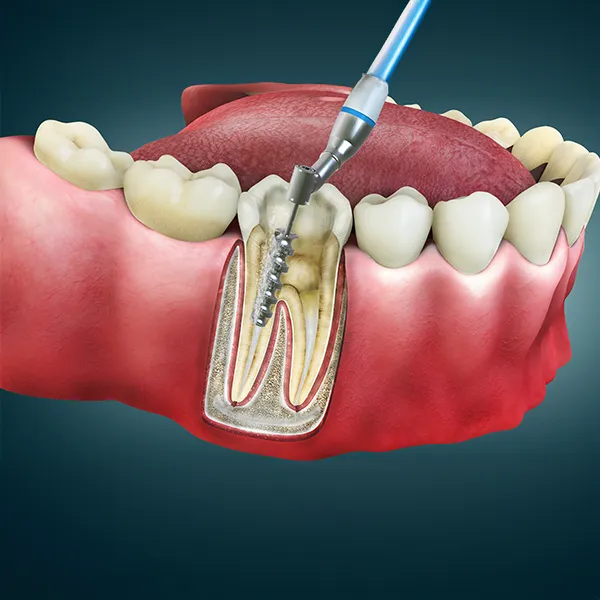 Root Canal