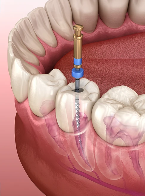 Root canal therapy, also known as endodontic therapy
