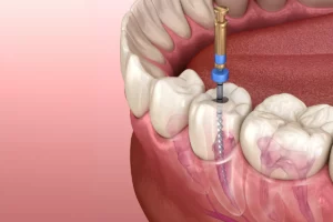 Root Canal Procedure