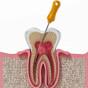 Root Canal