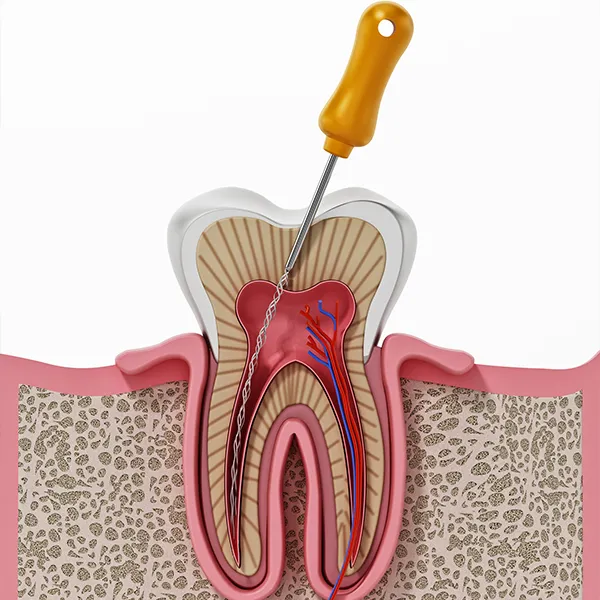 Root Canal