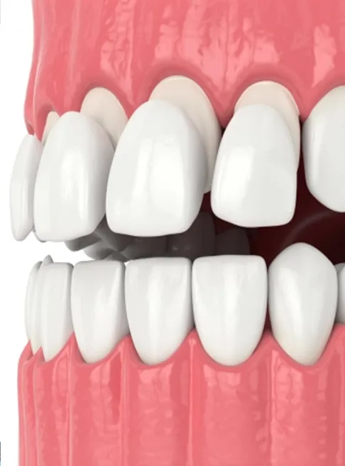 What Are Dental Veneers | West Village Dental Care | Dearborn, MI 48124