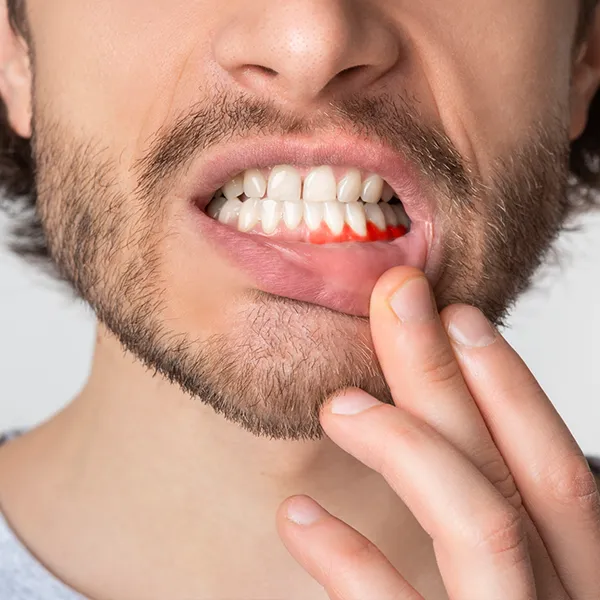 Abscessed Tooth Causes, Symptoms, & Treatment | West Village Dental Care | Dearborn, MI 48124