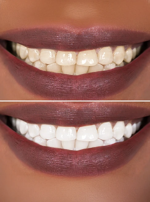 Understanding Teeth Whitening