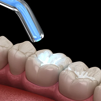 What Are Dental Sealants